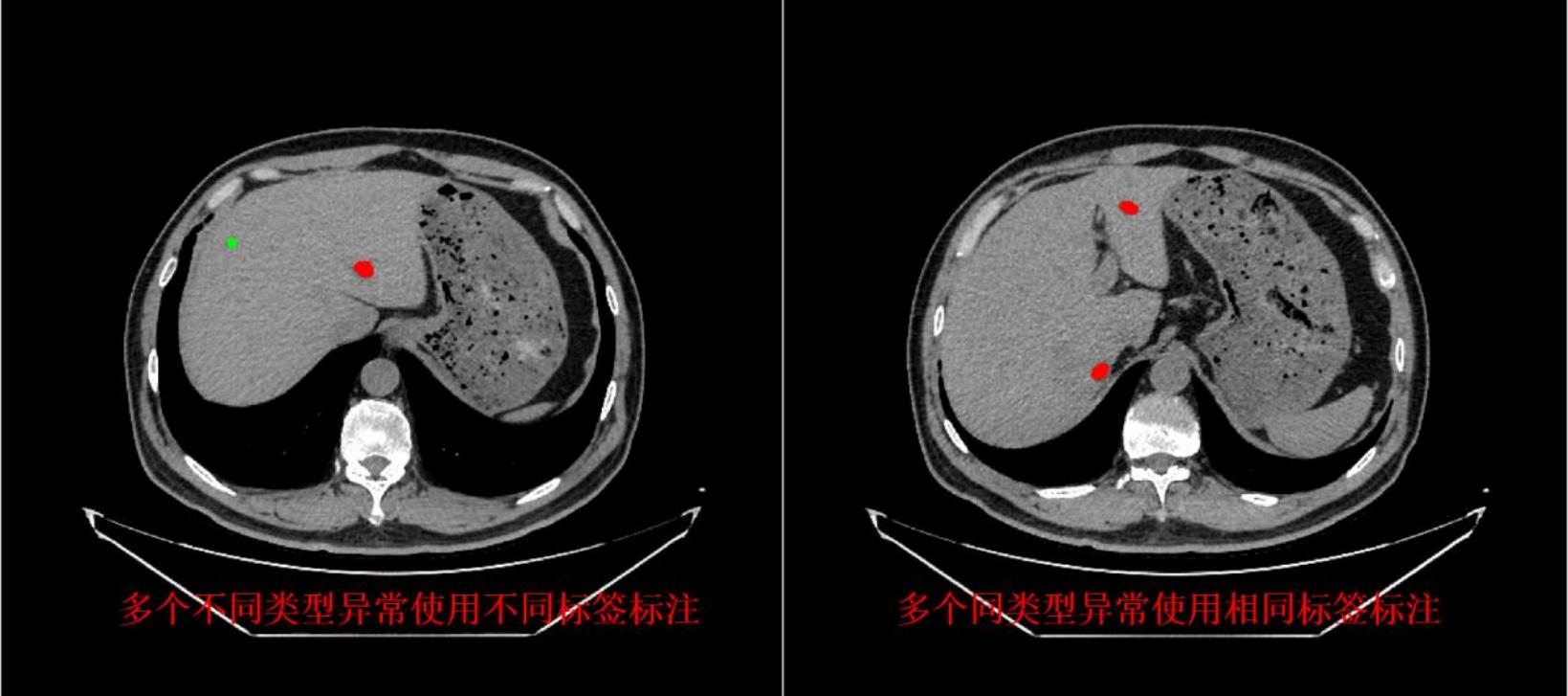 朗慧科技发布专业化上腹部CT智能标注解决方案，助力医学AI模型精准高效训练
