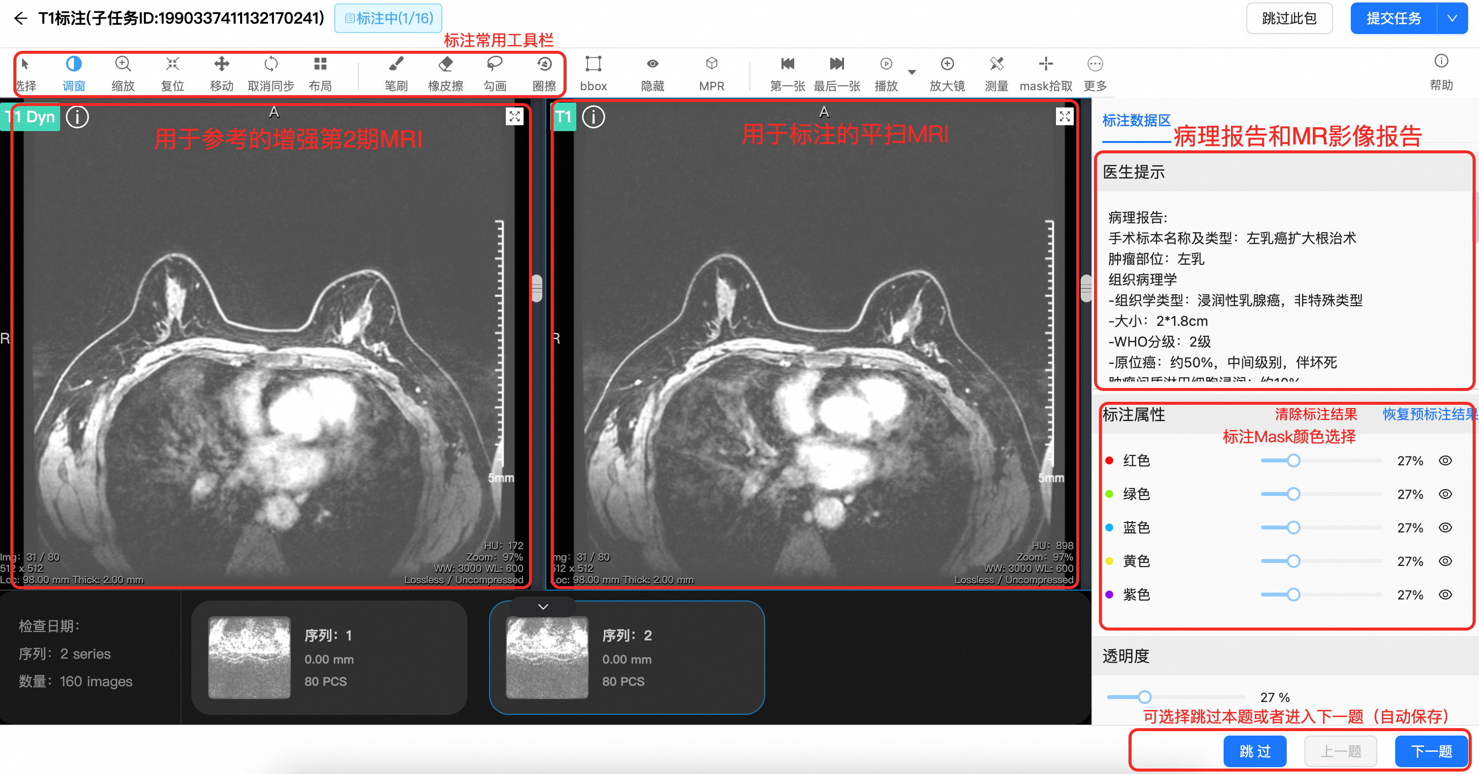 朗慧科技携手顶尖医疗伙伴，引领乳腺癌AI早筛标注新纪元