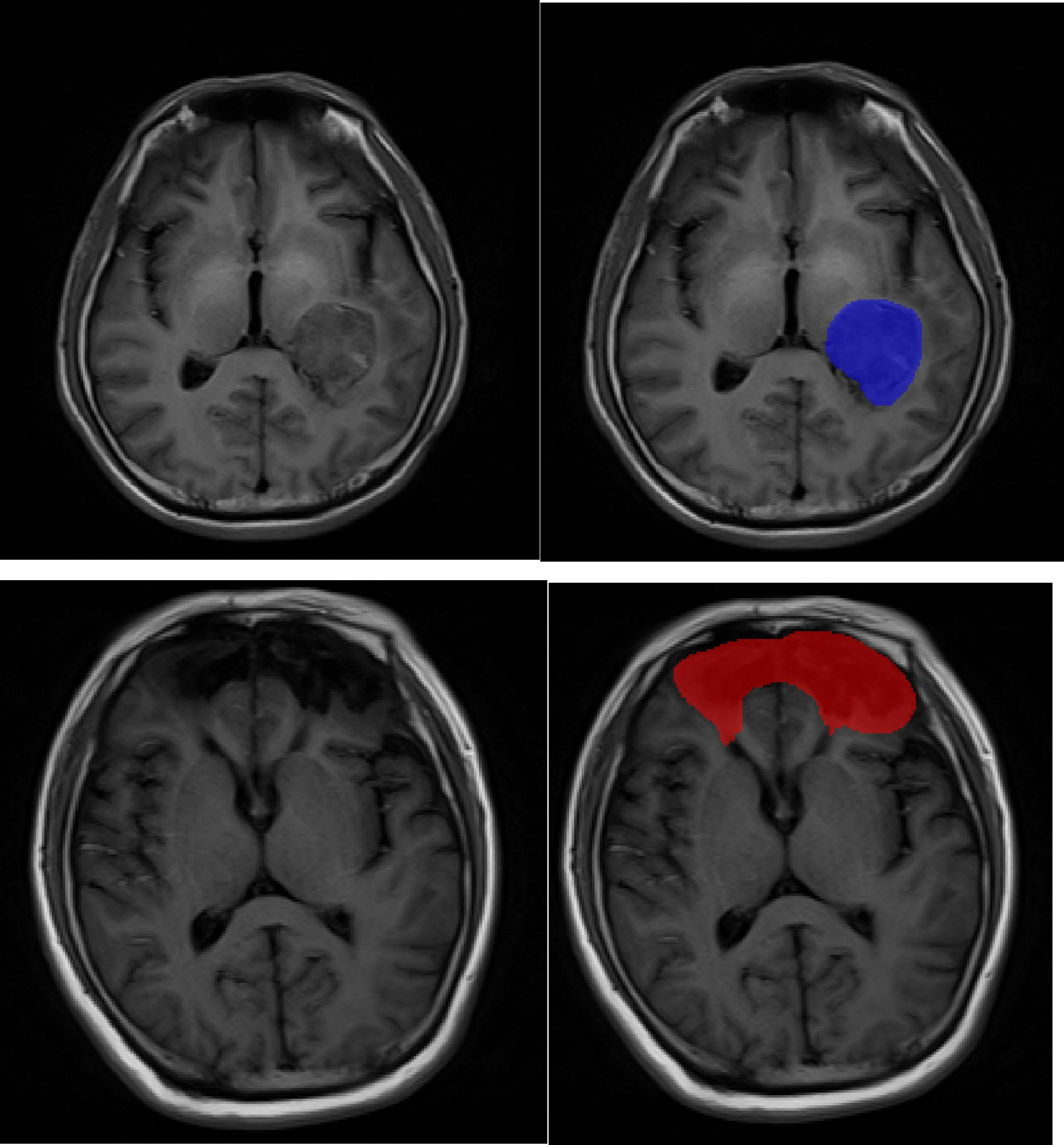 朗慧科技发布MRI颅脑AI项目精准标注解决方案，赋能医疗影像智能化诊断
